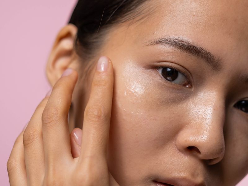 how seborrheic dermatitis is linked to oily, dry, or dehydrated skin