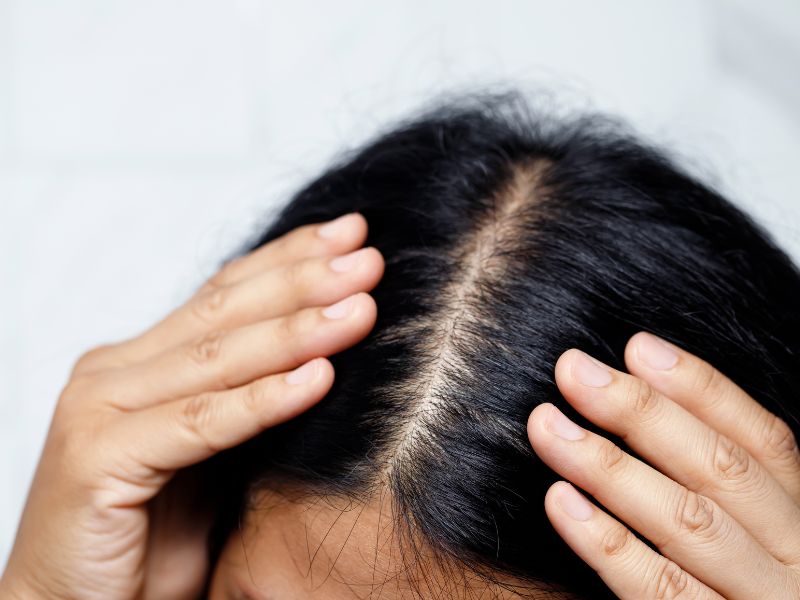 seborrheic dermatitis symptoms, causes, and treatment options