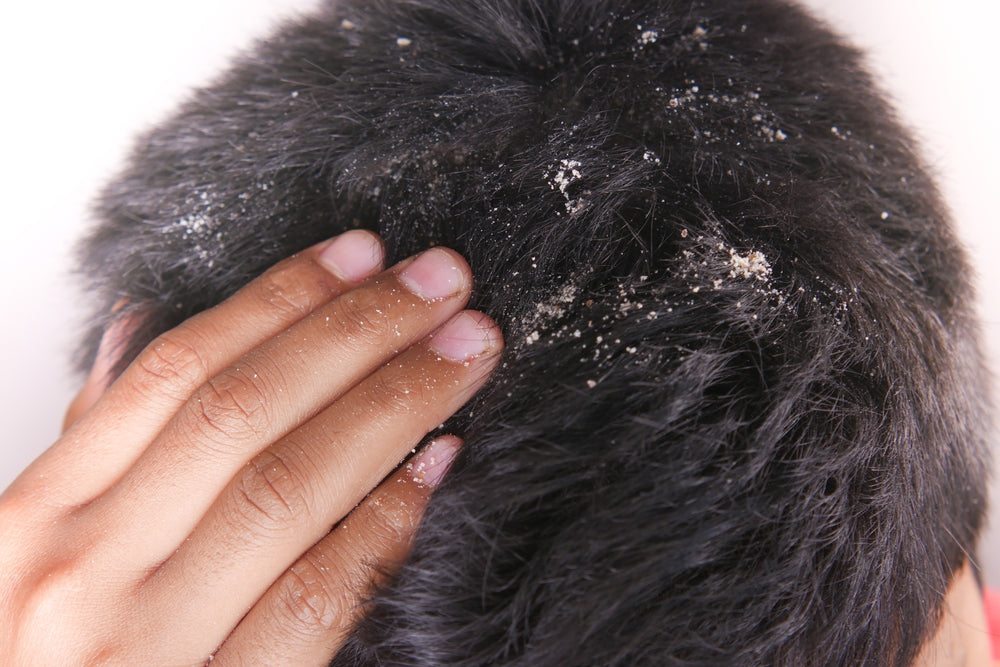 Why Dandruff Keeps Coming Back: Understanding the Flare Cycle